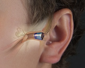 教你如何佩戴耳内式助听器